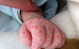 Trẻ bị sốt xuất huyết: Áp dụng một trong 4 cách sau sẽ nhanh khỏi bệnh tại nhà