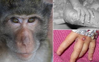 Bộ Y tế khuyến cáo 6 biện pháp phòng bệnh đậu mùa khỉ