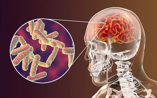 3 trường hợp tử vong do viêm não virus