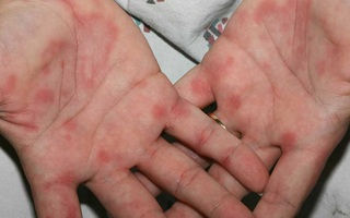 Nguyên nhân lòng bàn tay nổi đốm đỏ là gì? Cách điều trị như thế nào?