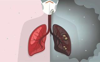 Chưa từng hút có thể ung thư phổi: "Thủ phạm" ẩn quanh mỗi người