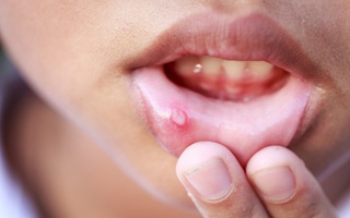Người đàn ông phải cắt bỏ 1/4 lưỡi vì ung thư: Bác sĩ cảnh báo dấu hiệu dễ bị bỏ qua