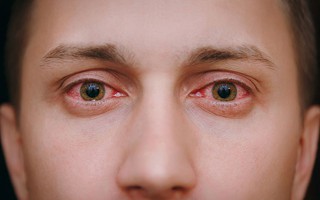 10 nguyên nhân gây đỏ mắt và cách điều trị