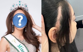 Hoa hậu Thái Lan đăng ảnh sẹo dài ở đầu sau phẫu thuật thẩm mỹ