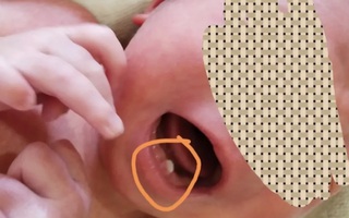 Bà nội tá hỏa phát hiện cháu gái mới sinh đã mọc răng