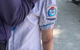 Bé gái 8 tuổi bị gãy tay do áo chống nắng cuốn vào bánh xe
