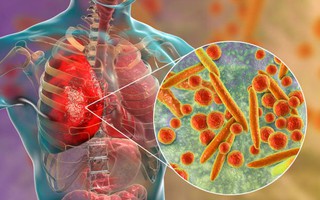 Viêm phổi do Mycoplasma: Dấu hiệu, nguyên nhân và cách điều trị