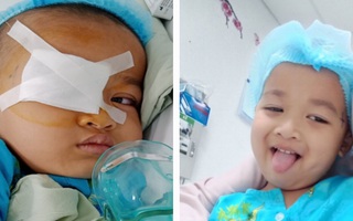Bị kéo đập vào mắt, bé 4 tuổi bị rách giác mạc, vỡ thuỷ tinh thể 