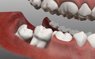 Nhổ răng khôn an toàn: Bác sĩ chia sẻ quy trình thực hiện tránh biến chứng