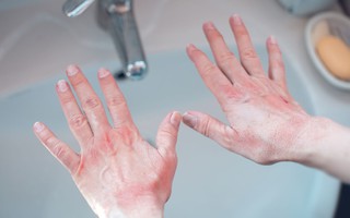 5 nguyên nhân cần chú ý khi bị phát ban do rửa tay