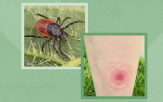 10 bệnh lý lây truyền từ bọ ve cần cẩn trọng