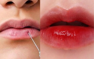 Từ vụ tắc mạch máu do tiêm filler môi, chuyên gia khuyến cáo điều quan trọng