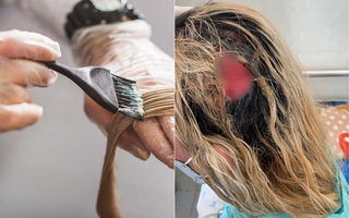 Làm gì để hạn chế tác hại không mong muốn khi hoại tử da đầu vì tẩy tóc?