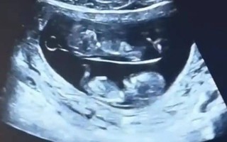Hình ảnh thai đôi chia làm 2 tầng trong bụng mẹ gây sốt