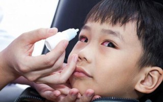 TPHCM: Đau mắt đỏ gia tăng, 1/3 ca mắc là trẻ em ở tuổi đi học