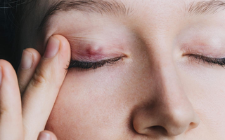 Nổi u trên mí mắt: Dấu hiệu ung thư hay bệnh lý khác?