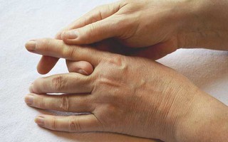 Bong gân ngón tay: Dấu hiệu nhận biết và cách điều trị