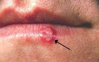 Bạn có thể bị mụn rộp do nhiễm virus Herpes khi đi bơi không?