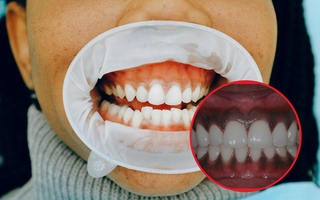 Lợi bị thâm đen có nguy hiểm không, cách điều trị thế nào?