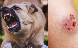 Cách xử lý vết thương ngay sau khi bị chó cắn, phòng ngừa bệnh dại