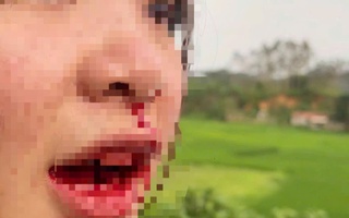 Cô gái 23 tuổi tố bị tài xế ô tô đánh chảy máu mồm