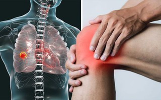 Cách nhận biết 4 dấu hiệu ung thư phổi ở chân dễ bị bỏ qua