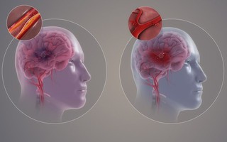 Phân loại bệnh mạch máu não và triệu chứng nhận biết sớm nhất