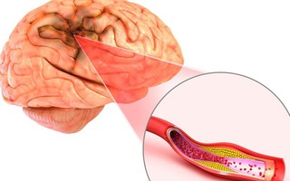 Từ A-Z về nguyên nhân và rủi ro sức khỏe gây đột quỵ mới nhất