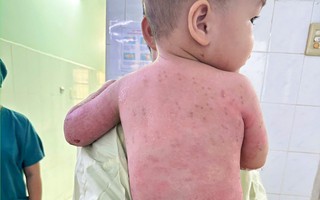 Bé trai 2 tuổi bị bỏng 60% được cứu sống nhờ ghép da từ mẹ