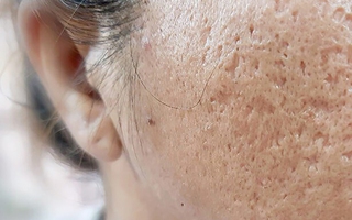 “Sẹo rỗ - Hiểu đúng, trị chuẩn”: Tránh “tiền mất tật mang” nhờ lời khuyên từ đội ngũ bác sĩ da liễu tại HKmedi
