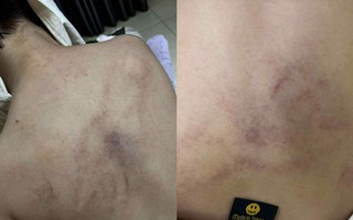 Xác minh thông tin bé gái 4 tuổi bị cô giáo đánh, kéo lê, ném vào tường
