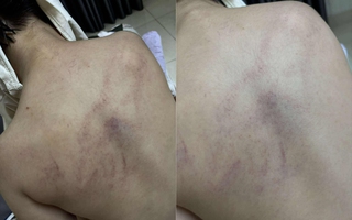 Vụ bé gái 4 tuổi bị cô giáo đánh, ném vào tường: Đang giám định thương tích làm cơ sở xử lý
