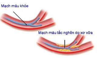Tại sao cần dự phòng bệnh xơ vữa động mạch ở người trẻ?