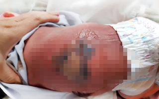 Bé sơ sinh bị bỏng nặng, nhiễm trùng máu khi nằm hơ than cùng mẹ
