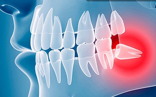 Nhận biết triệu chứng mọc răng khôn và cách xử trí