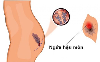 Ngứa hậu môn là gì? Căn bệnh khó nói và 9 điều cần biết