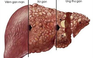 Đừng nhầm lẫn xơ gan cổ trướng và ung thư gan