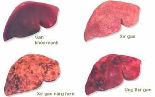 Cần lưu ý những gì trước khi xét nghiệm chẩn đoán xơ gan?