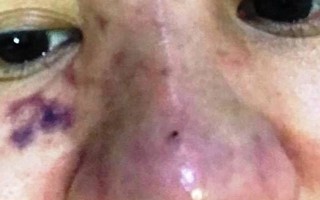 Tiêm filler tại Spa, mũi nữ sinh 23 tuổi sưng mọng như quả cà chua