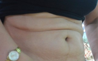 Bụng người phụ nữ biến dạng thành ‘6 múi’ sau khi hút mỡ