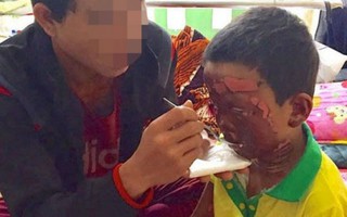 Bé 5 tuổi bị bỏng đến biến dạng mặt vì ngã vào bếp lửa