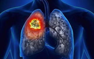 Dấu hiệu nhận biết ung thư phổi giai đoạn đầu