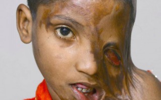 Khuôn mặt “tan chảy” của bé gái 8 tuổi bị cha tạt axit 