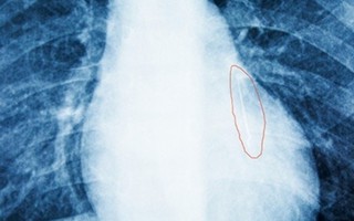 Kim khâu dài 2,5cm trong phổi bệnh nhi