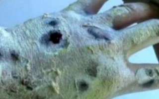 Sức tàn phá kinh hoàng của 'ma túy cá sấu' nguy hiểm nhất thế giới