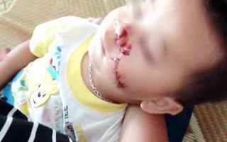 Bố say rượu, con 2 tuổi bị dao cứa rách mặt