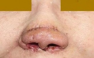 Dùng vành tai tái tạo cánh mũi cho nữ bệnh nhân