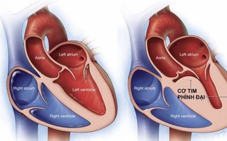 Virus lạ gây viêm cơ tim là đồn thổi không có căn cứ