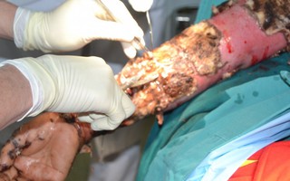 Đắp thuốc Nam trị bỏng, nữ bệnh nhân bị nhiễm trùng, chảy mủ ở cánh tay