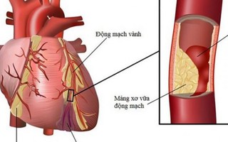 Bệnh tắc mạch do mỡ khiến bệnh nhân mổ tay tử vong là gì?